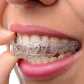 Best Invisalign in Kochi for Invisible and Comfortable Teeth Straightening